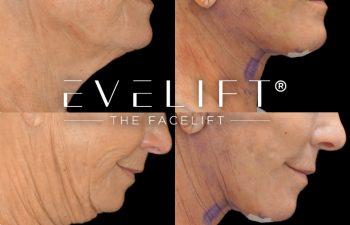 female patient before and after EVELIFT®