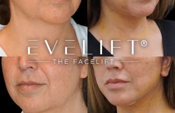 female patient before and after EVELIFT®