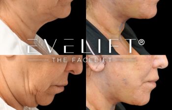 female patient before and after EVELIFT®