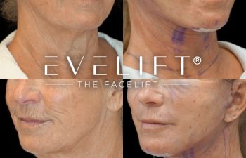 female patient before and after EVELIFT®