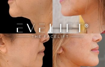female patient before and after EVELIFT®