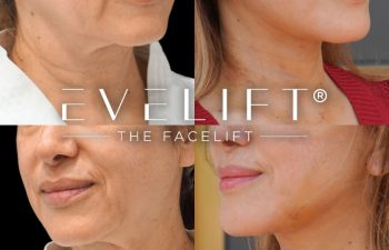 female patient before and after EVELIFT®