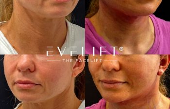 female patient before and after EVELIFT®