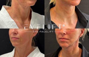 female patient before and after EVELIFT®