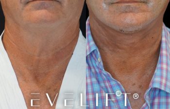 male patient before and after EVELIFT®