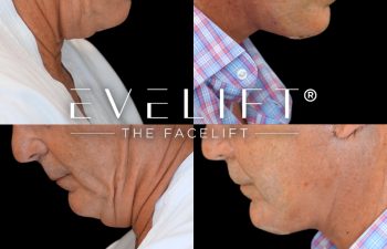 male patient before and after EVELIFT®