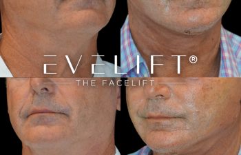 male patient before and after EVELIFT®