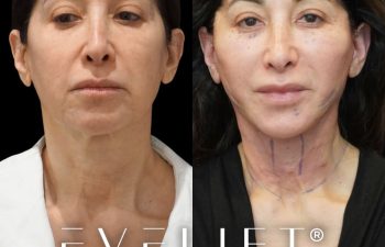 female patient before and after EVELIFT®
