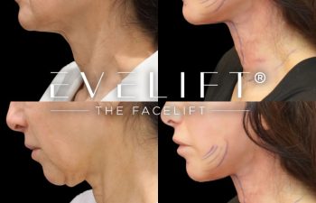 female patient before and after EVELIFT®