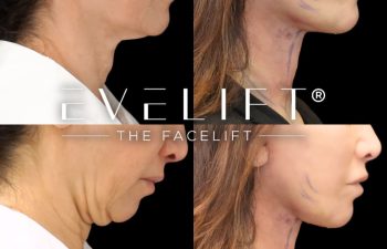 female patient before and after EVELIFT®
