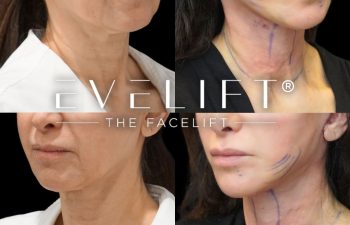 female patient before and after EVELIFT®