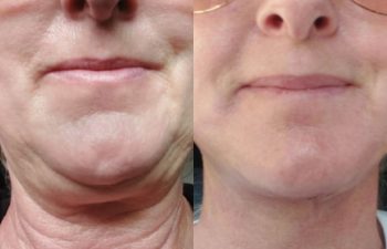 female patient before and after EVELIFT®