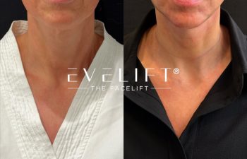 female patient before and after EVELIFT®