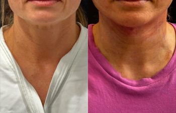 female patient before and after EVELIFT®