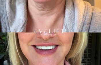 female patient before and after EVELIFT®