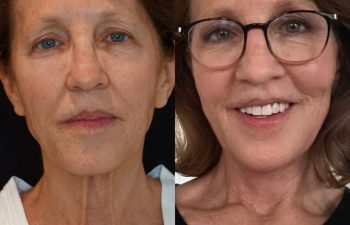 female patient before and after EVELIFT®