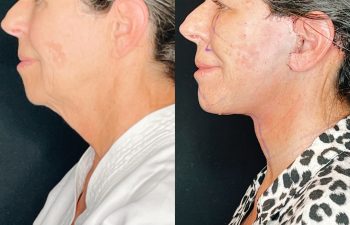 female patient before and after EVELIFT®