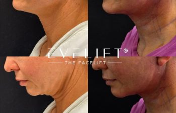 female patient before and after EVELIFT®