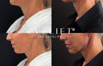 female patient before and after EVELIFT®