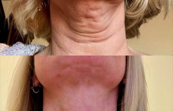 female patient before and after EVELIFT®
