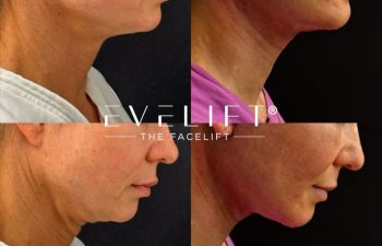 female patient before and after EVELIFT®