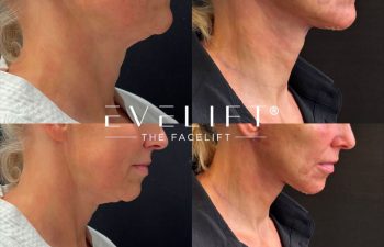 female patient before and after EVELIFT®
