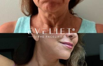 female patient before and after EVELIFT®