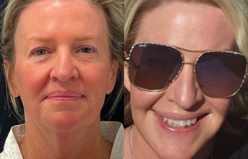 female patient before and after EVELIFT®