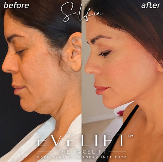 Eden Plastic Surgery Institute female patient before and after facial cosmetic surgery.
