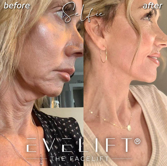Eden Plastic Surgery Institute female patient before and after facial cosmetic surgery.