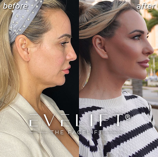 Eden Plastic Surgery Institute female patient before and after facial cosmetic surgery.