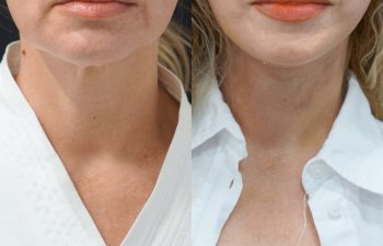 female patient before and after EVELIFT®