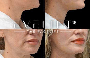 female patient before and after EVELIFT®