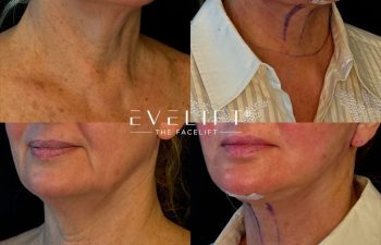 female patient before and after EVELIFT®