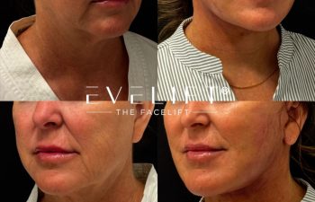 female patient before and after EVELIFT®