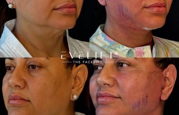 female patient before and after EVELIFT®