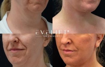 female patient before and after EVELIFT®