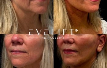female patient before and after EVELIFT®