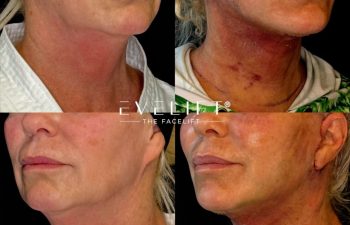 female patient before and after EVELIFT®