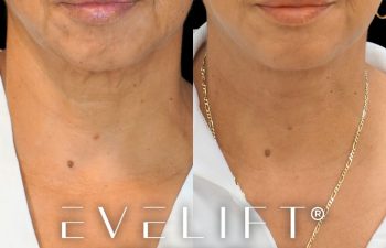female patient before and after EVELIFT®