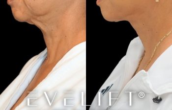 female patient before and after EVELIFT®