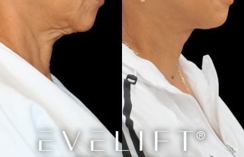 female patient before and after EVELIFT®
