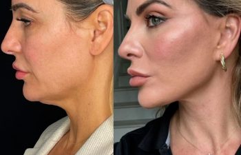 female patient before and after EVELIFT®