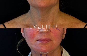 female patient before and after EVELIFT®
