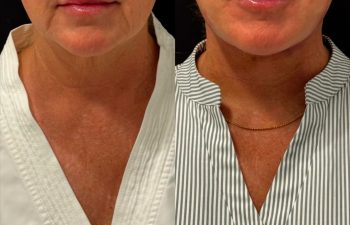 female patient before and after EVELIFT®