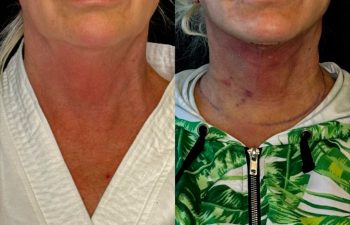 female patient before and after EVELIFT®