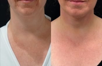 female patient before and after EVELIFT®
