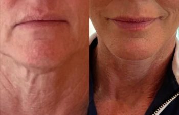 female patient before and after EVELIFT®