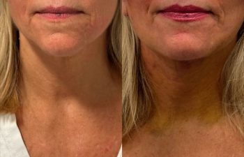 female patient before and after EVELIFT®