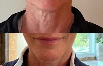 female patient before and after EVELIFT®